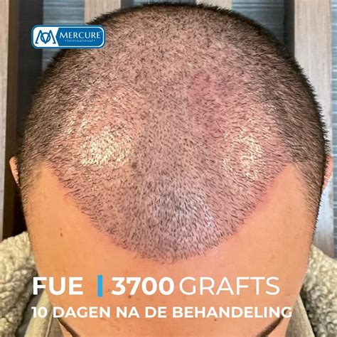 Saffier FUE: Een Pijnloze Haartransplantatie Ervaring