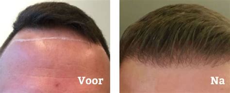 Wat Te Verwachten Na Een Haartransplantatie?