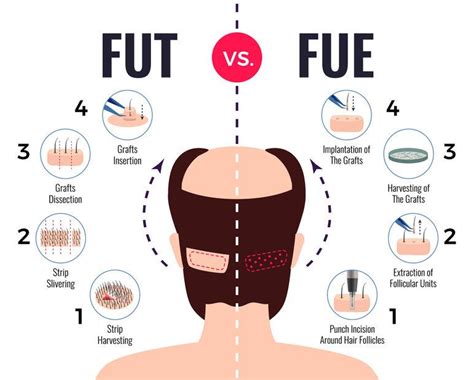 De Beste Haartransplantatie Technieken Voor Huidtypes