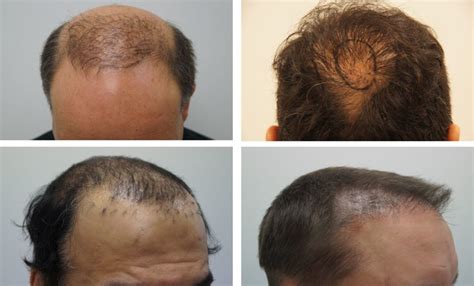 Debunking Myths Over Haartransplantatie