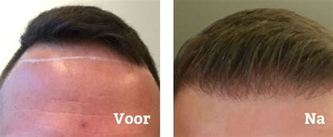 Haartransplantatie: De Meest Gestelde Vragen Beantwoord