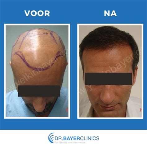 Haartransplantatie Voor En Na Foto’s: Inspiratie Of Realiteit?