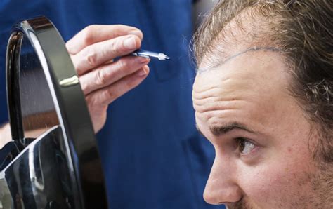 Hoe Bereid Je Je Voor Op Een Haartransplantatie?