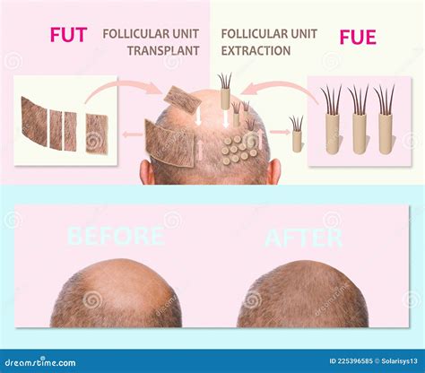 Verschillende Methoden Van Haartransplantatie