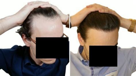 Wat Te Doen Voor Je Haartransplantatie: Voorbereidingen