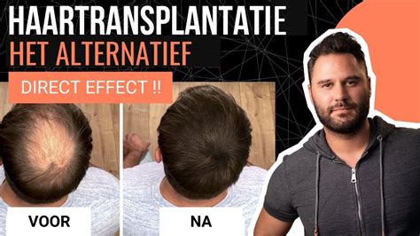 Haartransplantatie Dit En Dat: Feiten En Mythes