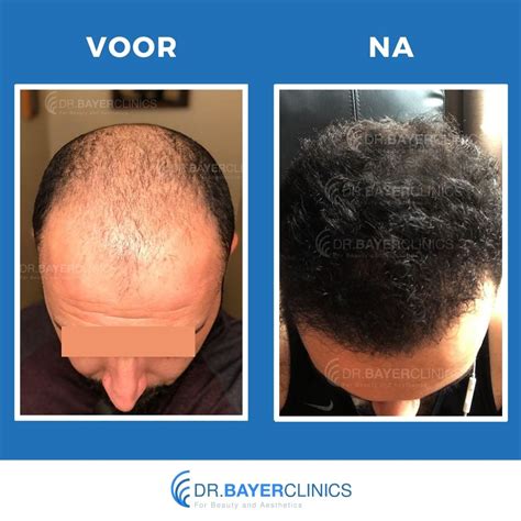 Haartransplantatie-Tips Voor Eerste Keren