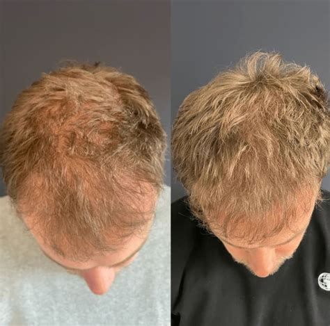 Haartransplantatie Na Verlies Van Haar: Een Persoonlijk Verhaal