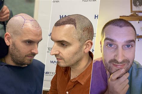 Haartransplantatie Bij Sporters: Is Het Aanbevolen?