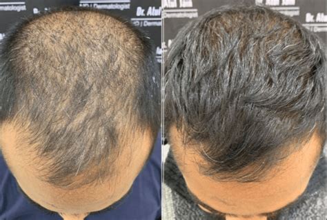 Haartransplantatie En Herstel: Wat Je Moet Weten