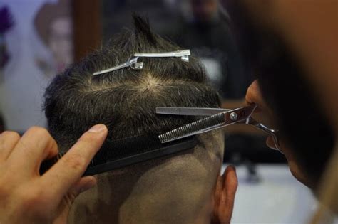 Verschillende Technieken Van Haartransplantatie Uitleggen