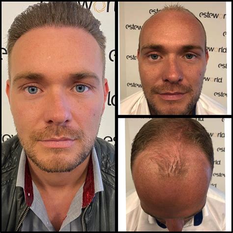 Ervaringen Met Haartransplantatie Deel: Mijn Verhaal