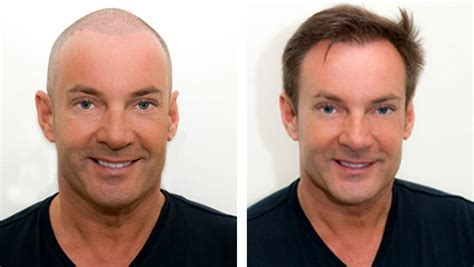 Haartransplantatie Voor En Na Foto's: Inspiratie