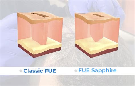 Saffier FUE Vs. Traditionele FUE: Wat Is Het Verschil?